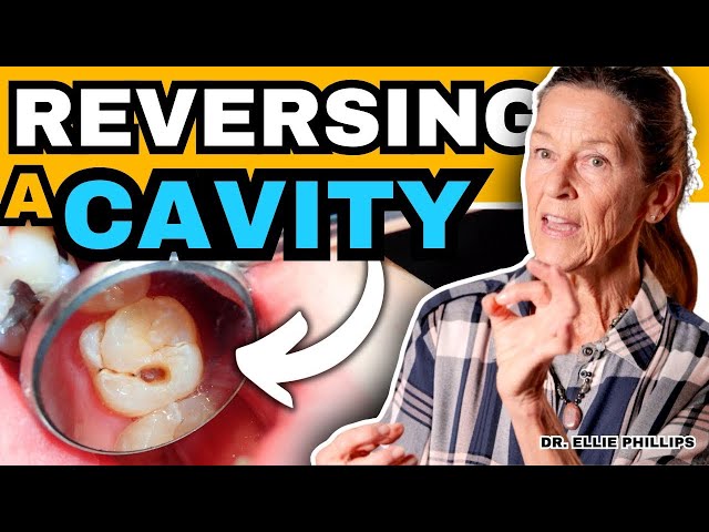 How To Reverse a Cavity at Home | Cure Tooth Decay