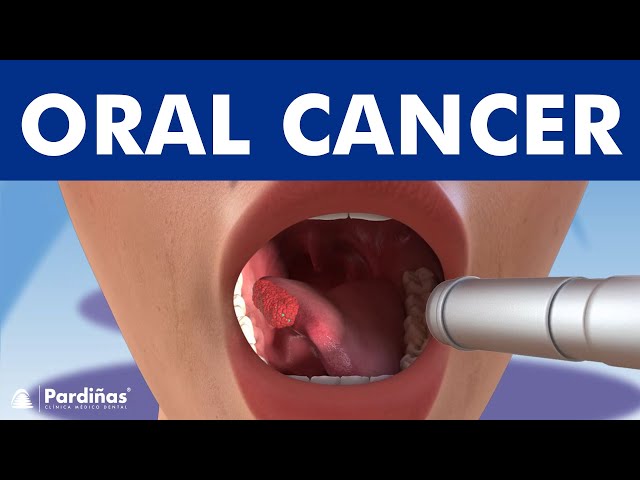 ORAL CANCER and tumors in the mouth, lips and tongue ©