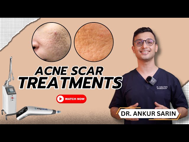 How I Treat Acne Scars | Dermatologist | Best devices Morpheus Dermapen 4 | l Dr Sarin |