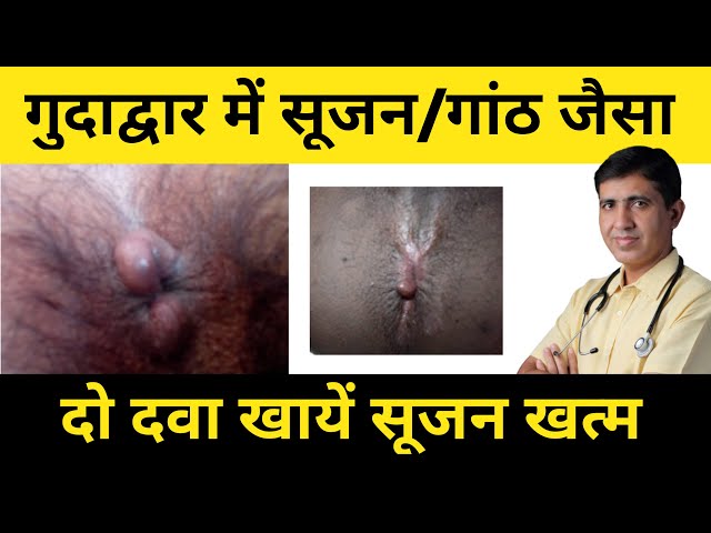 गुदा द्वार में सुजन / गाँठ का इलाज | गुदा द्वार में गाँठ जैसा निकलना | Anus Swelling Treatment