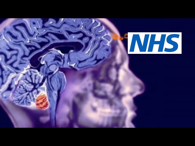 Benign brain tumour: Debbie's story | NHS