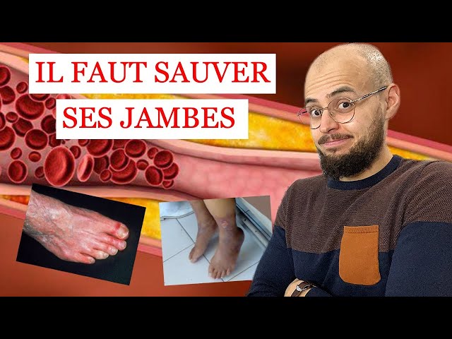 ARTÈRES des jambes BOUCHÉES et ULCÈRE de la PEAU: ce qu'il faut savoir !