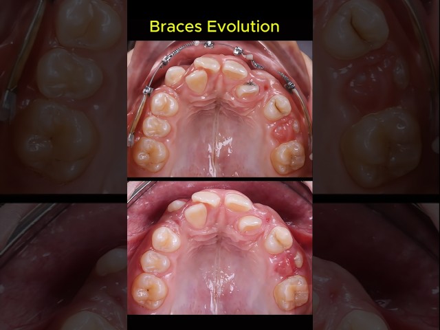 Braces evolution transform teeth #orthodontist #braces #dentist #dentistry