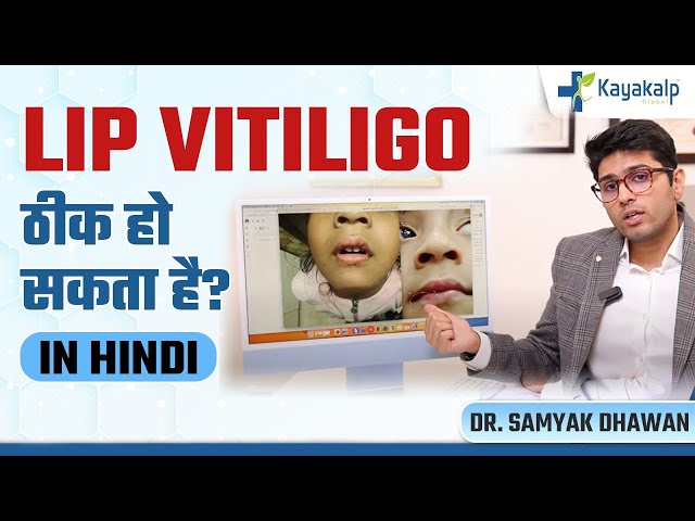 Lip Vitiligo ठीक हो सकता है? | Lip Vitiligo Treatment Case Study | Kayakalp Global