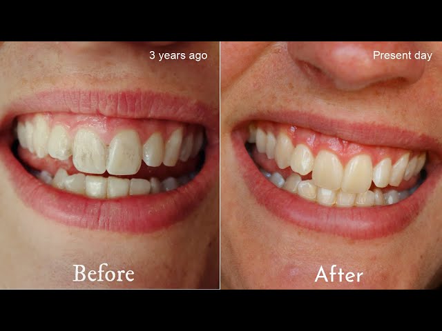 DIY Remineralising Toothpaste || Restore tooth enamel naturally