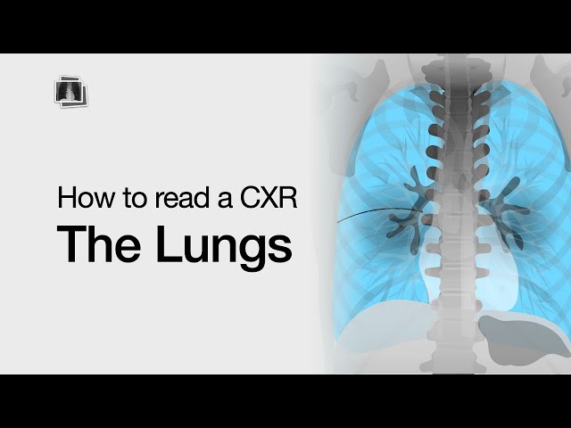 How to Read a Chest X-Ray: The Lungs