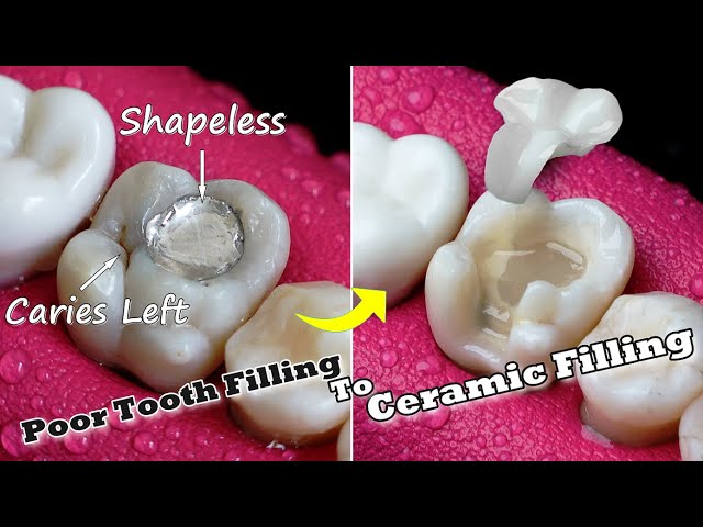 Old Silver Tooth Filling Replaced by Zirconia Tooth Filling | Unbelievable Reconstruction