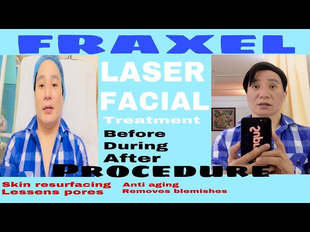 FRAXEL FACIAL LASER- FACIAL RESURFACING, PAMPAKINIS AT PAMPABATA