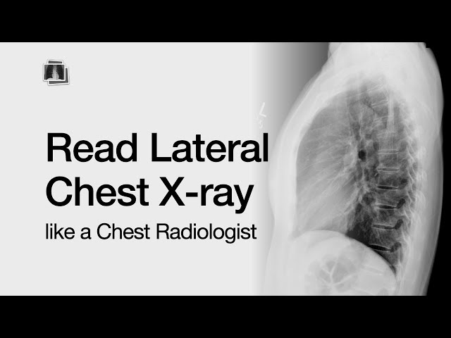 How to Read a Lateral Chest X-Ray