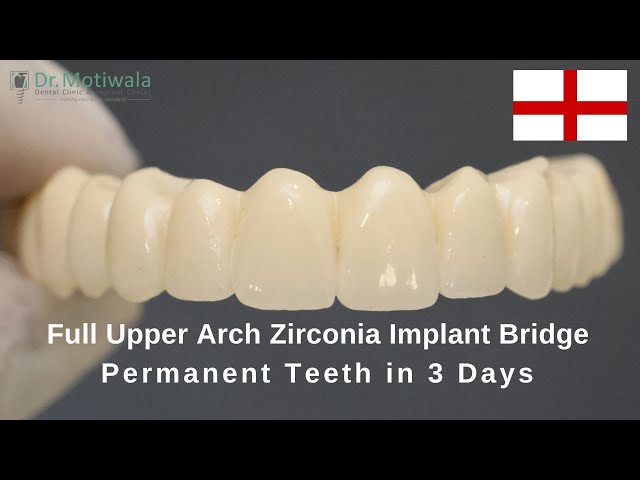 Transformation with Full Upper Arch Zirconia Implant Bridges in India #bestdentalclinic | PT3D