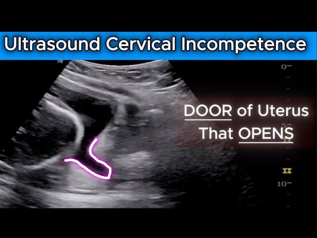 Cervical Incompetence | Ultrasound 22wks Pregnancy - Diagnosis - Complications - Causes - Treatment