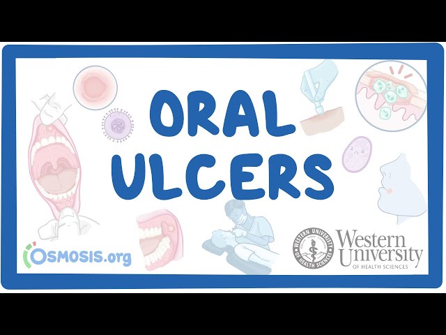 Western University - Oral Ulcers