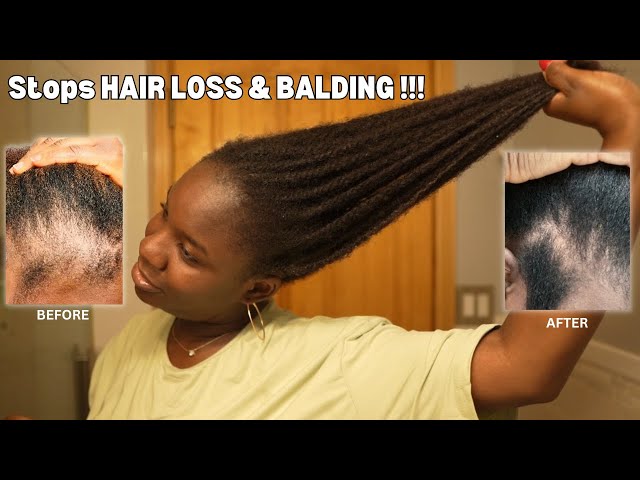 Use This Once a Week and Your Hair Will Never Stop Growing| DIY for HAIR LOSS & BALDING‼️