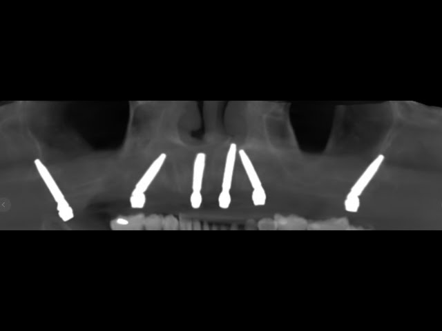 pterygoid implant open flap surgery with STRAUMANN NEODENT implant - best lase dental clinic-Chennai