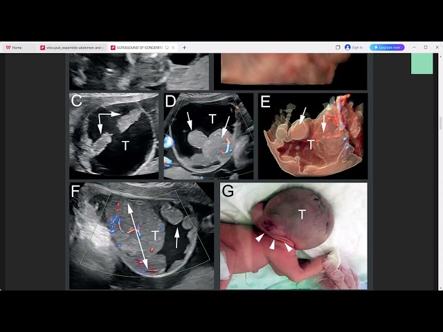 ULTRASOUND OF CONGTENIGTAL ANOMALIES