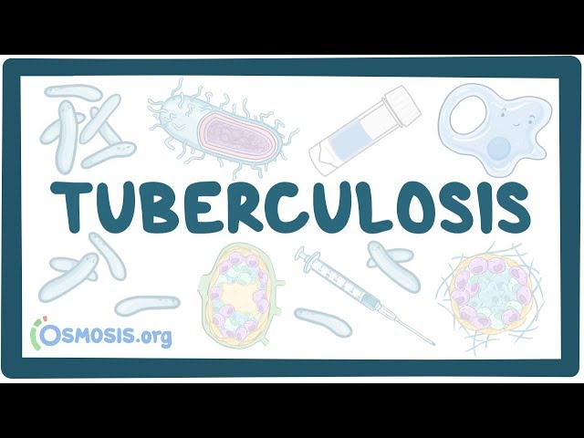 Tuberculosis - causes, symptoms, diagnosis, treatment, pathology