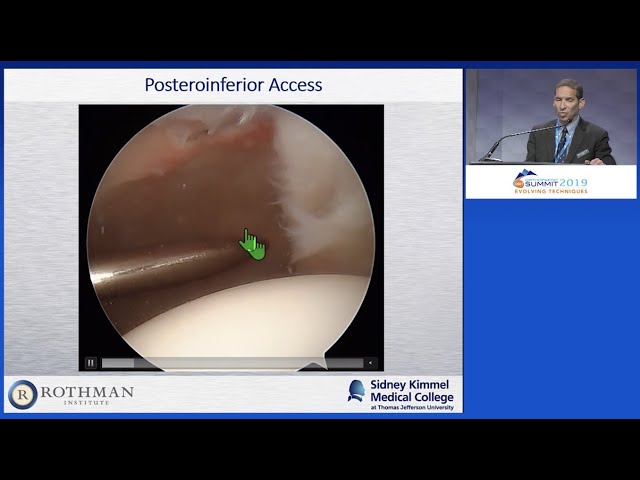 Posterior Labral Tear: 5 Minutes, 5 Steps In The Lateral Decubitus Position - Mark Getelman, MD