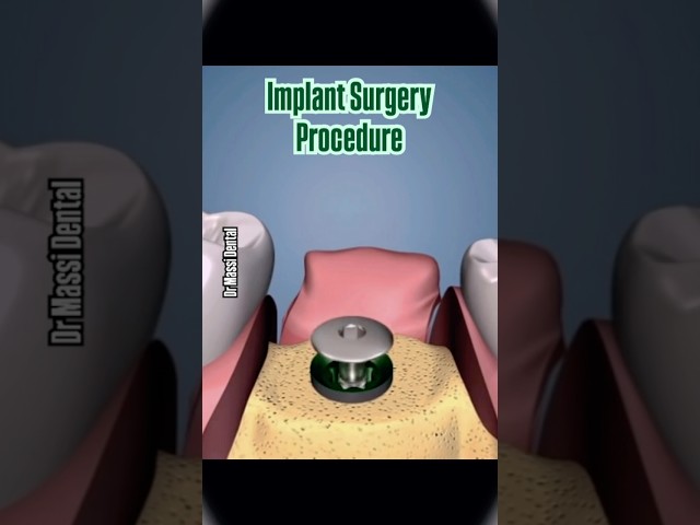 Implant Surgery Procedure