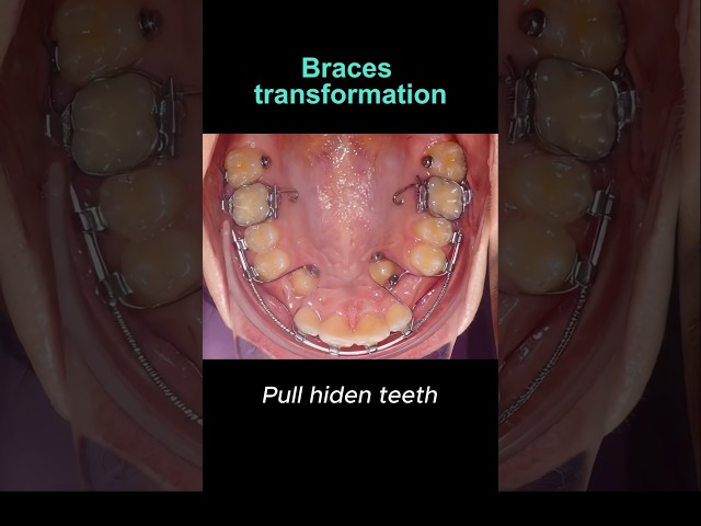 Braces transformation. Hiden teeth, not problem  #braces #orthodontist #dentist #dental