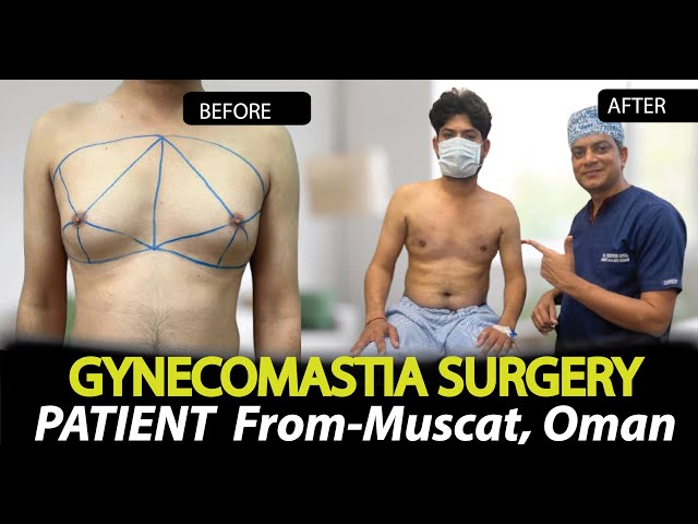 Gynecomastia Surgery Success Story | Patient from Oman | Dr Deepesh Goyal Rejuvena Cosmo Care Jaipur