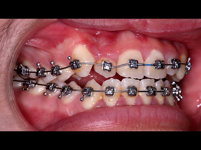 24 Months - Braces before and after #braces #orthodontist #dentist