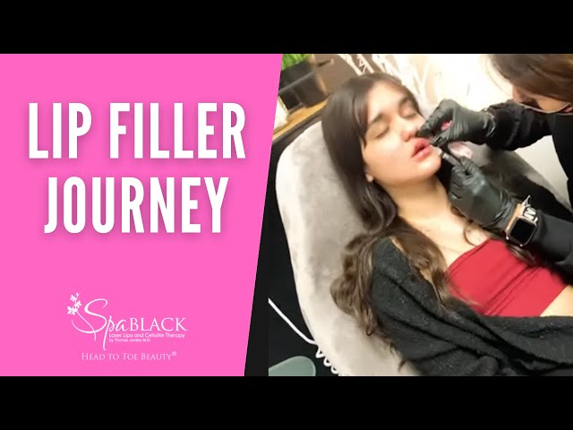 Spa black San Antonio Lip Filller Injection procedure journey