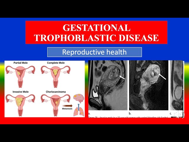 GESTATIONAL TROPHOBLASTIC DISEASE - Definition, types, causes,  symptoms , diagnoses , medicine