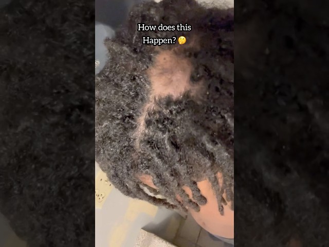 Loc bald spot 😫 HOW did this happen? 🥹 #locs #locjourney #naturalhair #shorts