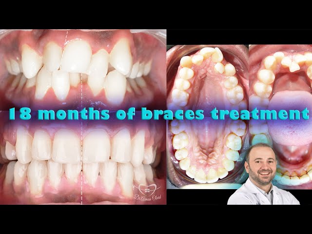 Sever teeth crowding and bite problem has been solved in 1.5 year, sever teeth asymmetry correction