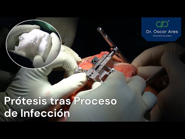 Prótesis tras proceso de infección