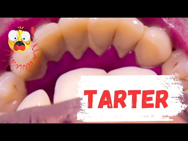 Remove Tarter  From Teeth