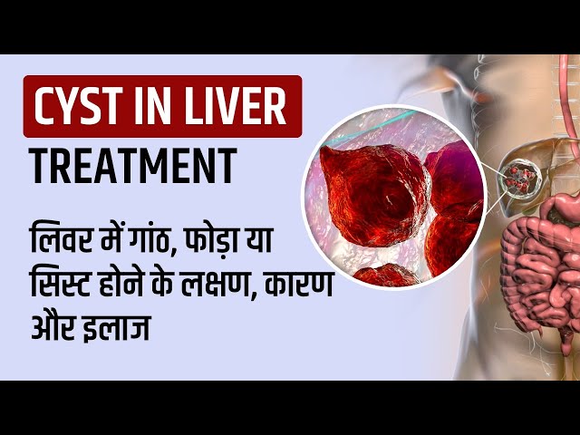 Cyst in Liver in Hindi, Symptoms, Treatment, लिवर में गांठ, फोड़ा या सिस्ट होने के लक्षण कारण और इलाज