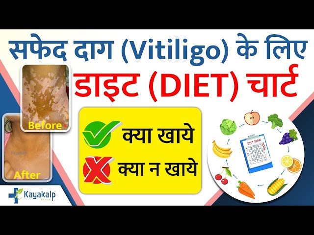 Vitiligo Diet Plan/Chart in Hindi | सफेद दाग | Vitiligo Foods to Eat & Avoid | Kayakalp Global