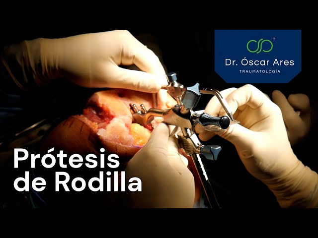 Prótesis de Rodilla (Artrosis evolucionada) - Dr. Oscar Ares