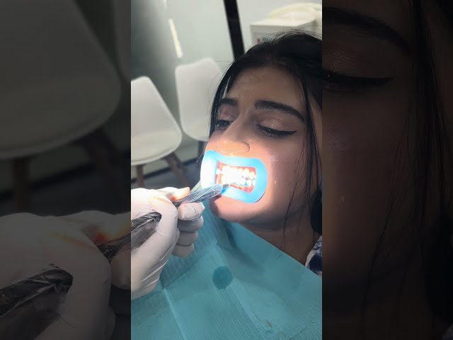 Whiten Your Teeth in 15 Minutes | Step By Step Teeth Whitening Procedure By Female Dentist in Lahore