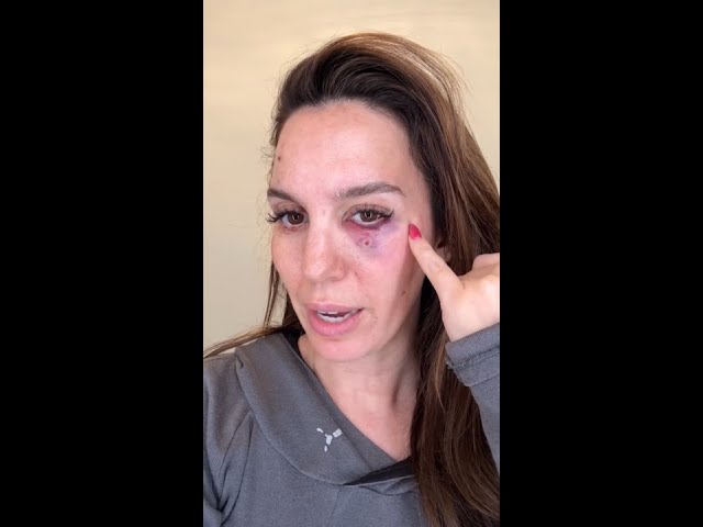 Former Disney star shot in the face