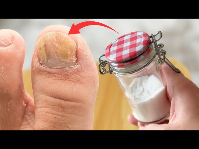 If I died I wouldn't know - NAIL FUNGUS disappears immediately! ( NATURAL SOLUTION )