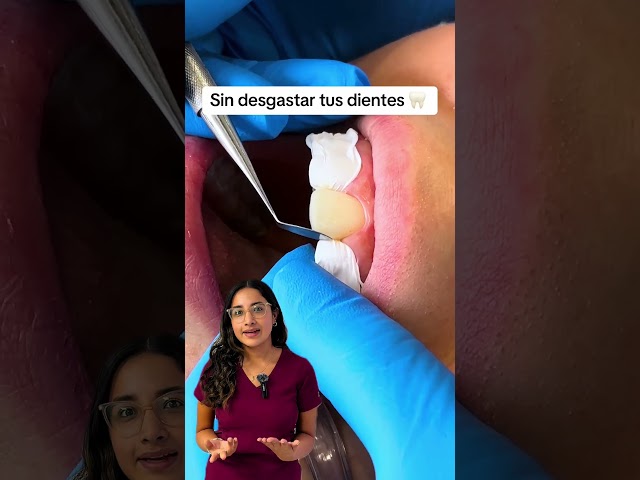 🎯 Título: ¡Bordes incisales en resina! 😁✨ Mejora tu sonrisa sin desgaste 🦷💎