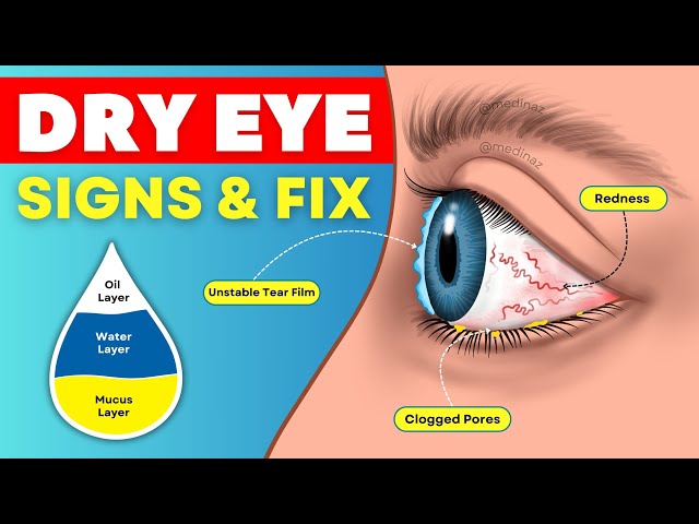 6 Dry Eye Signs You’re Ignoring 😱 & Natural Ways to Fix it