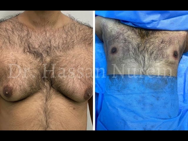 Before & Immediately After Gynecomastia Surgery Results | Dr Hassan Nurein