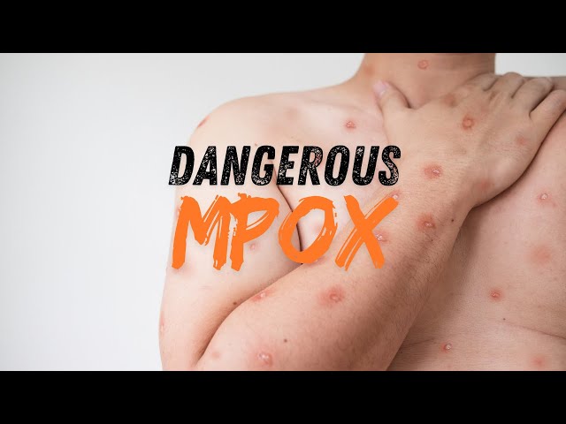 Beware of Mpox.. Its on the Rise Globally.