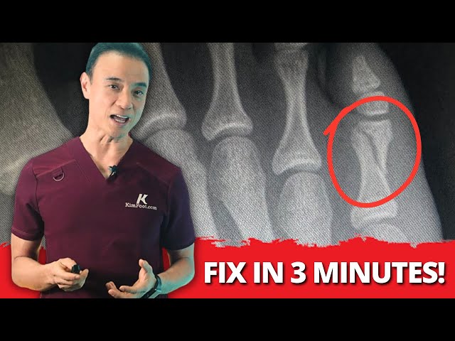 How to Fix a Broken Toe at Home in 3 Minutes | Quick & Easy Recovery Tips