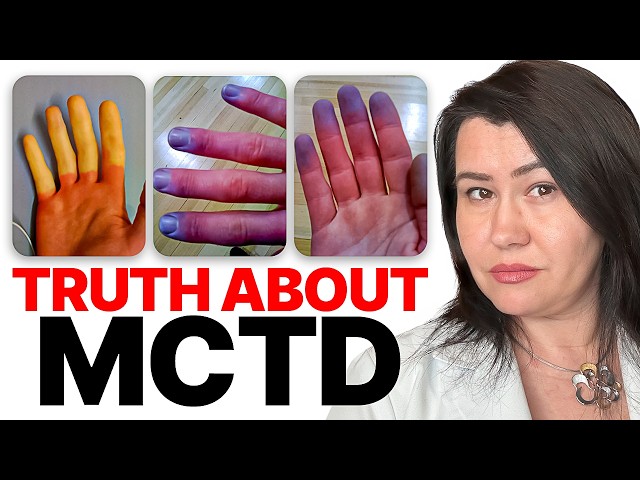 MCTD Treatment EXPLAINED, and #1 Thing You MUST Know!