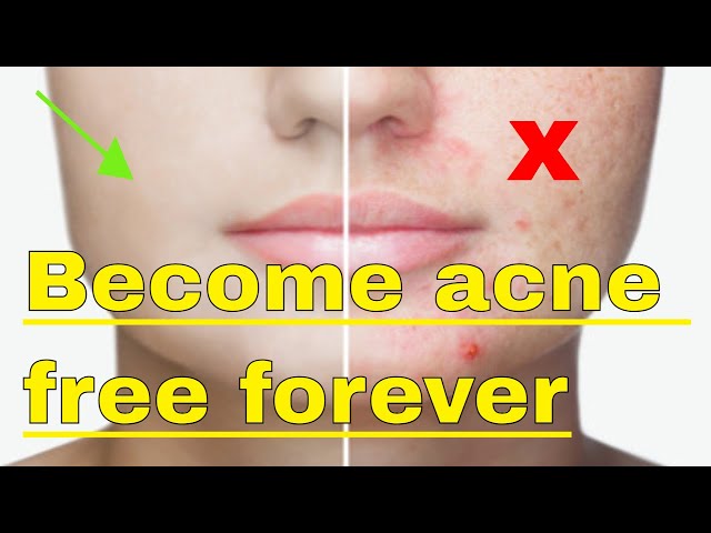 10 Easy and Natural Ways to Get Rid of Acne Keep your face clean