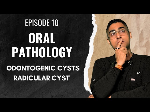 Dental Digest | Oral Pathology | Episode 10 - Radicular Cyst