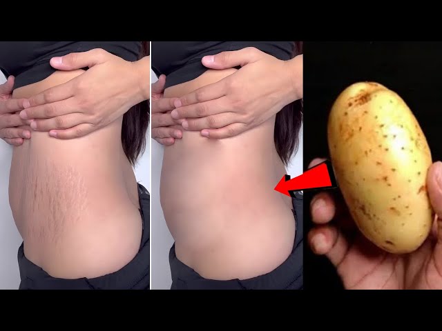 😮Remove stubborn Stretch Marks Scars in 2 Days Permanently, REMOVE STRETCH MARKS NATURALLY