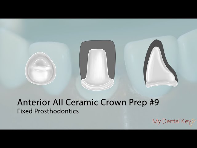 PASS THE CDCA - All Ceramic Anterior Crown Preparation | My Dental Key