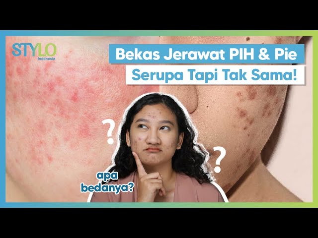 Perbedaan Bekas Jerawat PIE dan PIH, Ternyata Beda Cara Mengatasinya! | Stylo