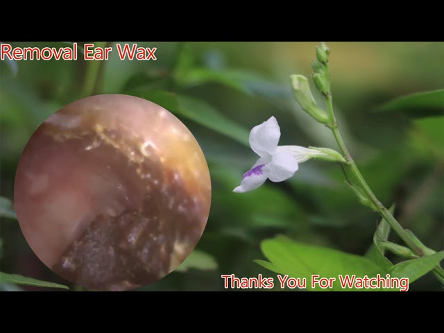 Removal of Ear Wax from Entire Ear Canal