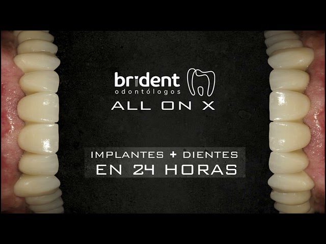 ALL ON X: IMPLANTES+DIENTES EN 24 HORAS